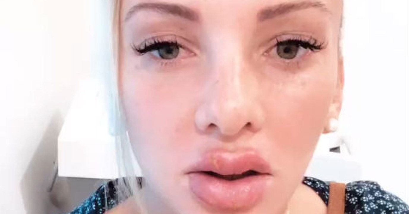 Ex-Bachelor-Kandidatin: Nach OP platzen ihr die Lippen auf