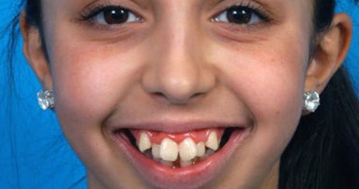 Zahnfehlstellung: Nach mehreren Operationen ist sie nicht mehr wiederzuerkennen
