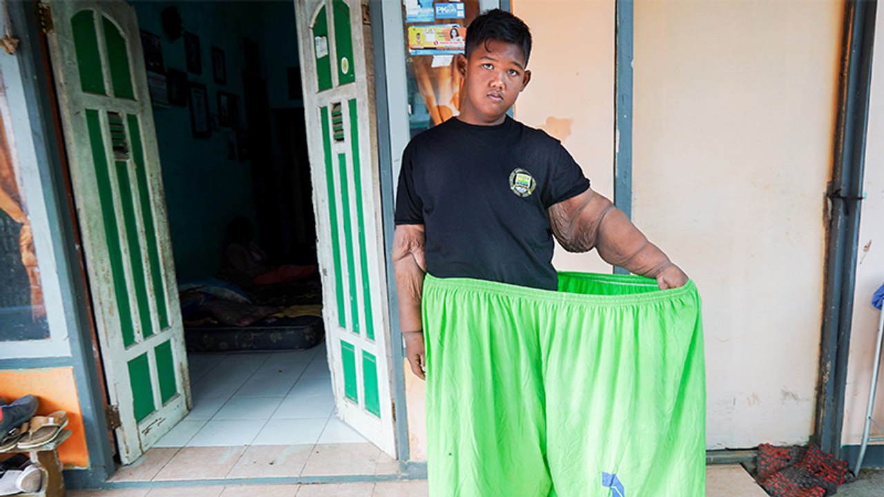 Arya Permana: So sah das damals 'Schwerste Kind der Welt' vor seiner Verwandlung aus