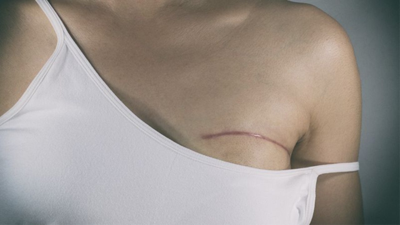 Junger Mutter werden Brüste entfernt, doch dann erkennen die Ärzte fatalen Fehler