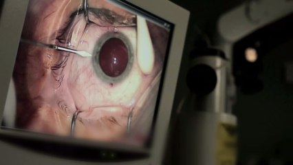 Grauer Star: Mit diesen Anzeichen kannst du ihn früh erkennen