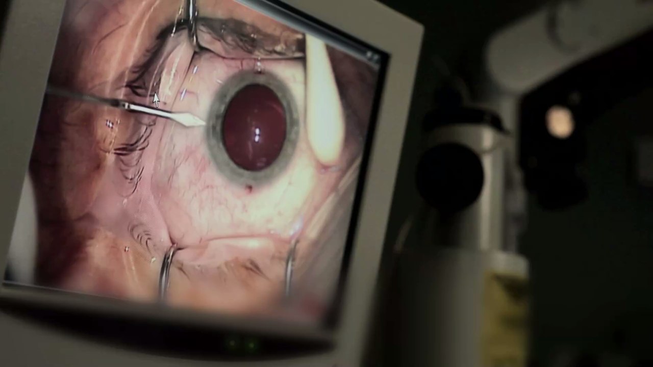 Grauer Star: Mit diesen Anzeichen kannst du ihn früh erkennen