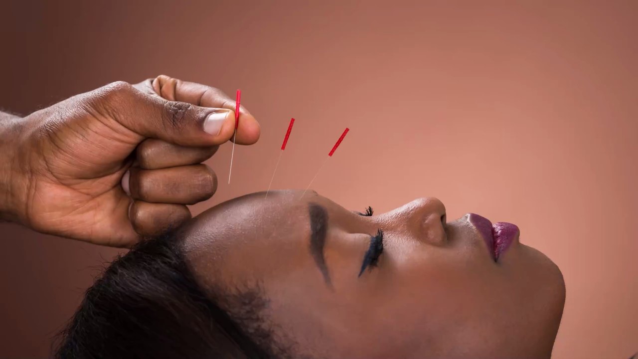 Kosmetische Akupunktur: So funktioniert der neue Beautytrend