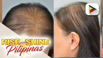 Mga sanhi ng alopecia o hair loss, alamin!
