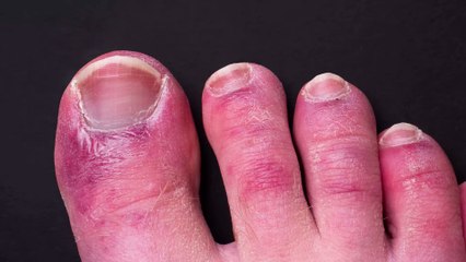 Von wegen "Corona-Zehen": Auch die Corona-Impfung kann die Farbe unserer Zehen und Finger verändern