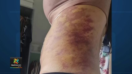 tn7-Vecina-de-Coronado-denuncia-mala-praxis-tras-cirugía-estética-010222