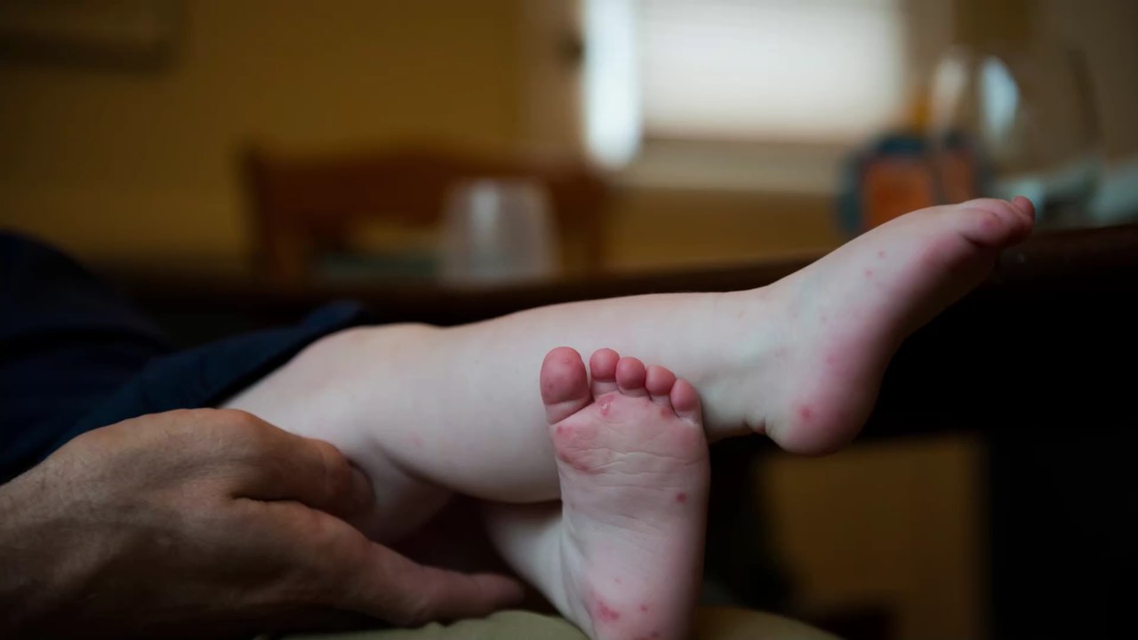 Hoch ansteckende Kinderkrankheit breitet sich verstärkt in Deutschland aus