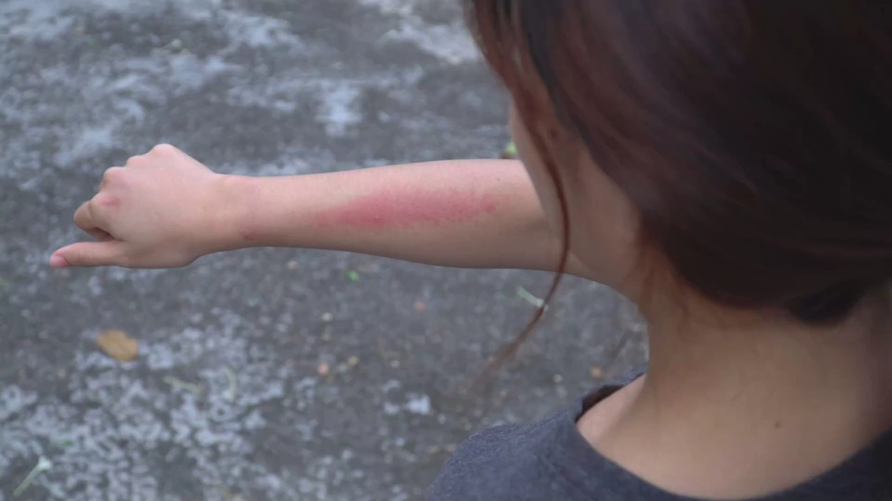 Neurodermitis: Darauf solltet ihr beim nächsten Klamotten-Kauf achten