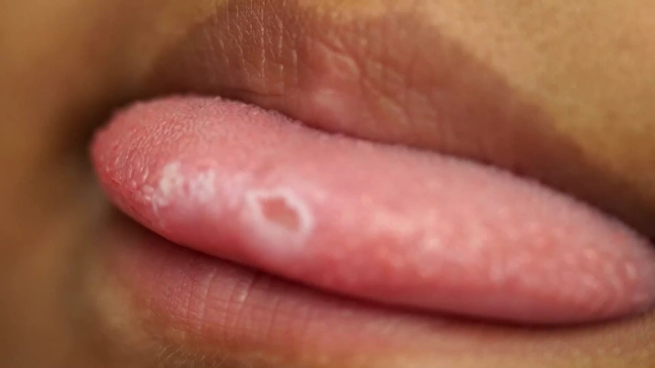 Saure Bonbons brennen 4-jährigem Mädchen Loch in die Zunge