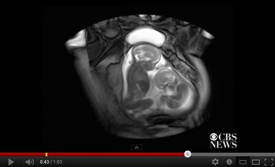 Observez ces deux jumeaux se battre dans le ventre de leur mère