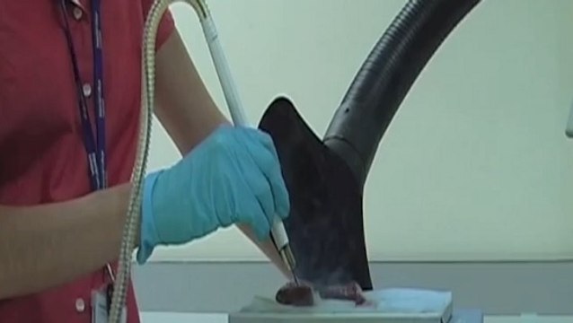 Cancer : un bistouri intelligent capable de distinguer les tissus sains des tumeurs