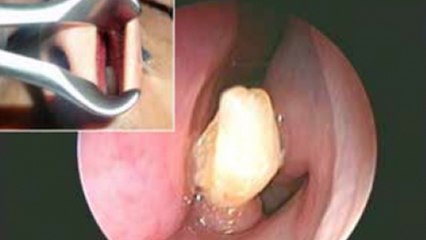 Des médecins lui retirent une dent... dans le nez