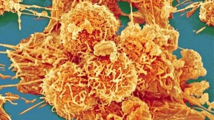 Cancer : 65% des cas seraient liés à de la ''malchance'', selon une étude