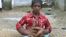 La mystérieuse maladie d'un jeune Indien aux mains devenues énormes