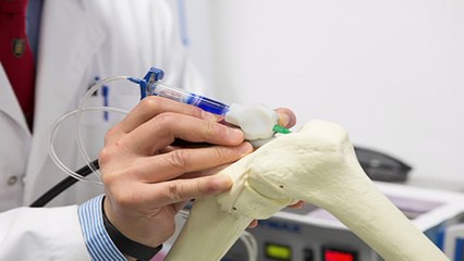 BioPen : le stylo qui pourrait aider vos fractures à guérir plus vite