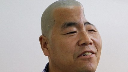 Des médecins reconstruisent le crâne d'un homme grâce à l'impression 3D