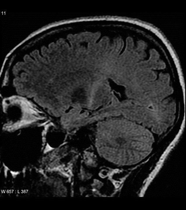 ALS Krankheit: Symptome, Lebenserwartung, Diagnose, Ursachen, was ist das?