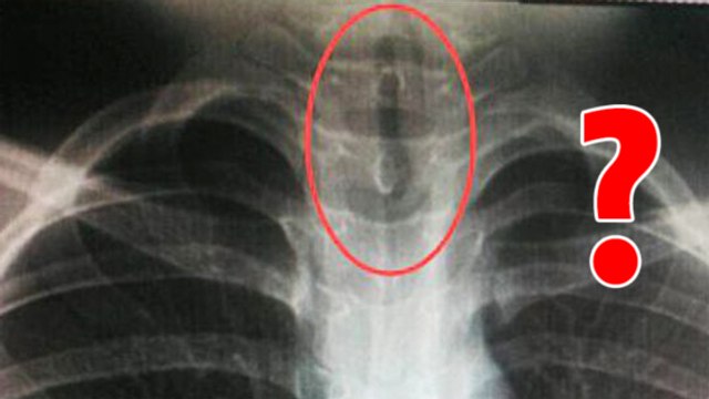 Des médecins chinois font une effrayante découverte dans la gorge d'un patient