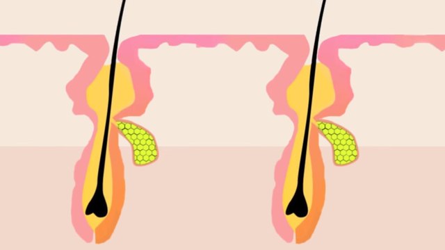 Comment apparaissent les boutons d'acné ?