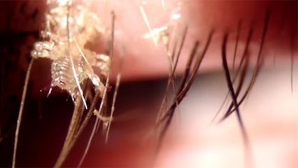 Une effrayante infection des yeux qui va vous donner des cauchemars