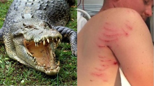 Attaqué par un crocodile, cet Australien a survécu grâce à un réflexe étonnant