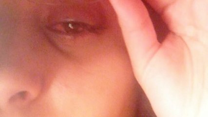 Une effrayante infection de l'œil empêche une étudiante de dormir pendant une semaine