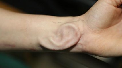 Une patiente se fait greffer une oreille cultivée dans son avant-bras