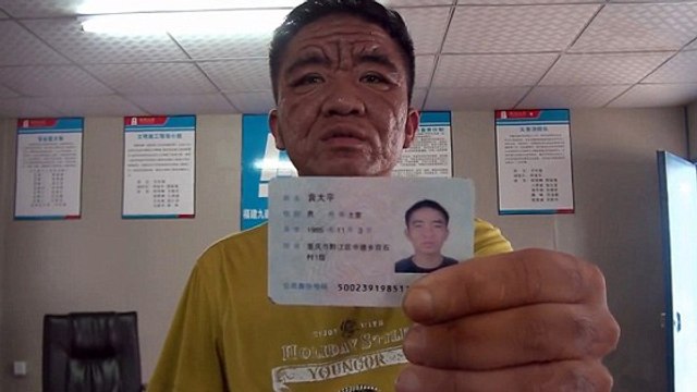 L'étrange maladie de ce Chinois de 30 ans qui ressemble à un vieillard
