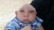 Jaxon, le bébé atteint d’une rare malformation célèbre son premier anniversaire