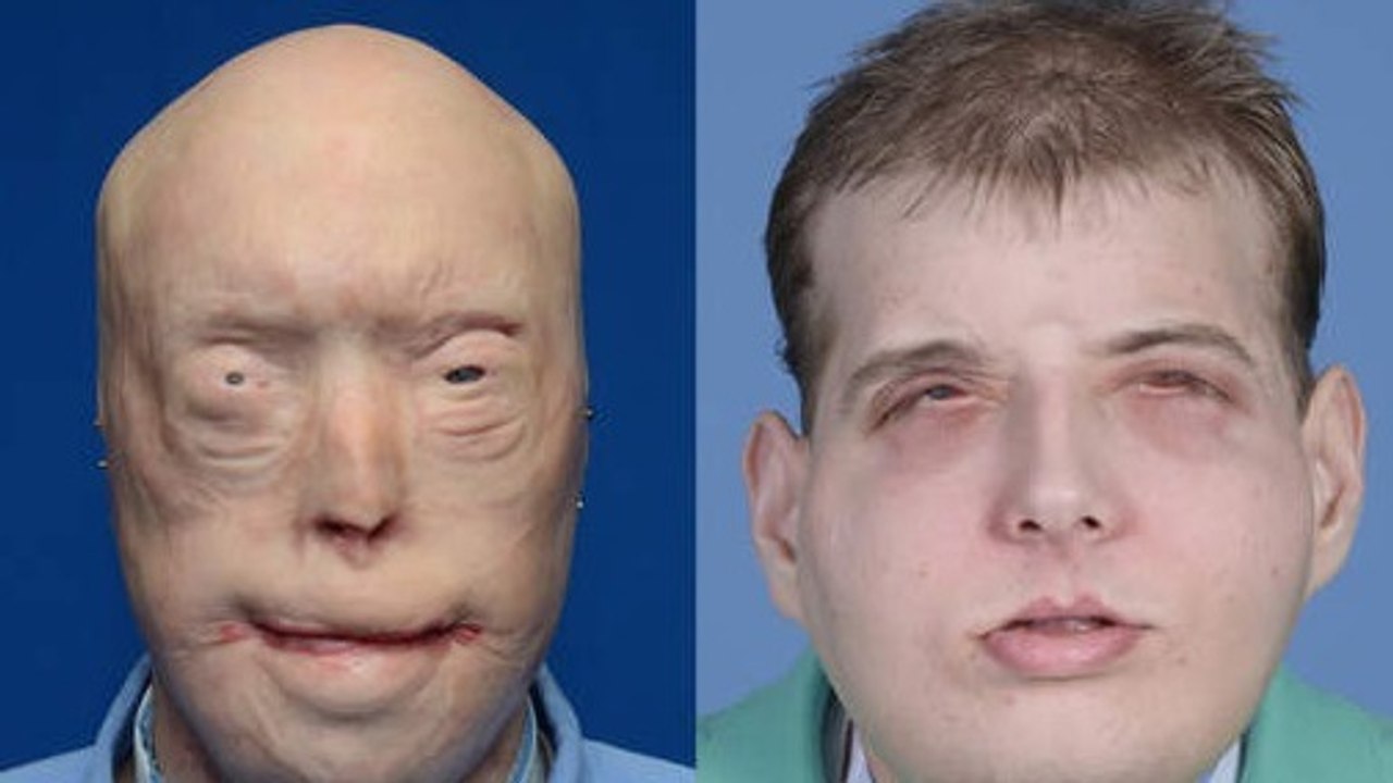 Un pompier américain reçoit la greffe de visage la plus complète menée à ce jour