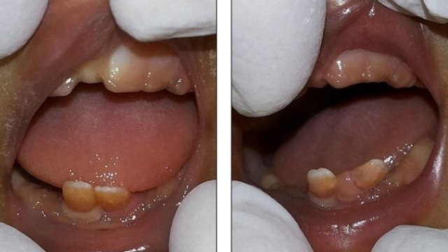 Inde : Un cas extrêmement rare de jumelles nées avec des dents