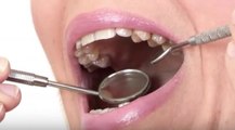Bientôt des dents en verre bioactif pour lutter contre les caries ?