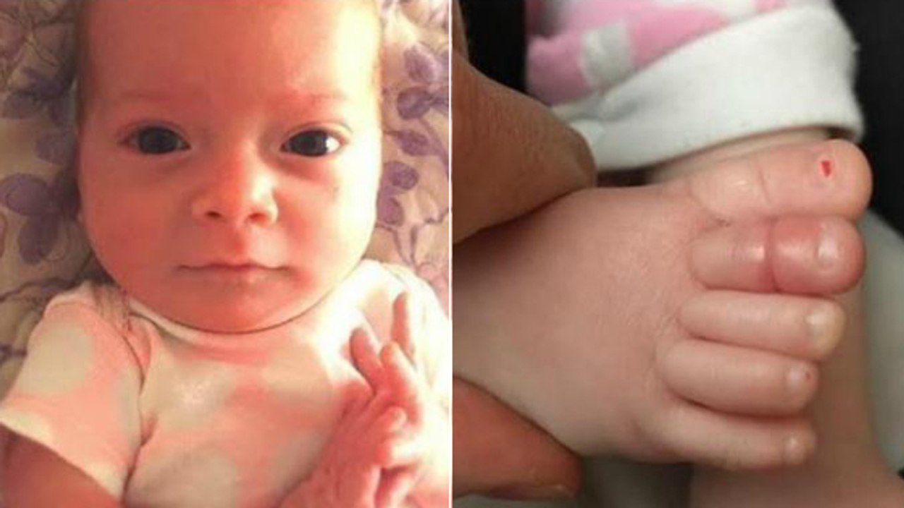 Le syndrome du tourniquet : comment un simple cheveu peut être dangereux pour votre bébé