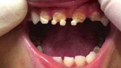 Cet enfant se retrouve avec les dents ravagées par une substance bien connue