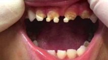 Cet enfant se retrouve avec les dents ravagées par une substance bien connue