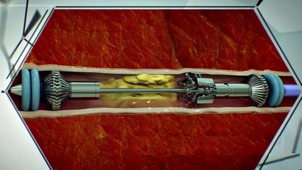 Cette invention pourrait sauver des millions de personnes d'une maladie cardiovasculaire