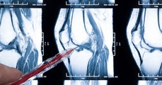 IRM du genou : définition, comment se passe un examen, et y a-t-il des risques ?