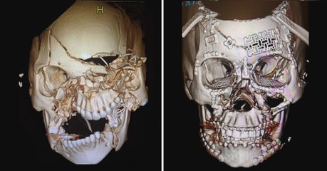 Un médecin montre l'incroyable reconstruction faciale d'une patiente après un grave accident de la route