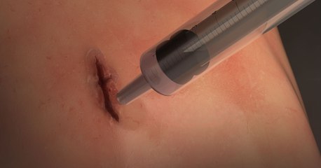 Cette innovante colle chirurgicale pourrait permettre de dire adieu aux sutures