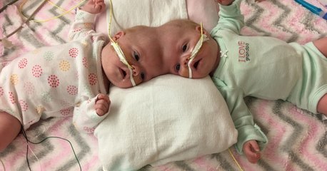 Siamoises : des chirurgiens mènent une délicate opération pour séparer des jumelles reliées par la tête