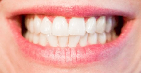 Un traitement révolutionnaire contre les caries pourrait signer la fin des plombages