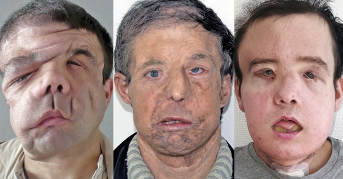 Jérôme Hamon, l'homme aux trois visages se porte bien après sa seconde greffe complète du visage