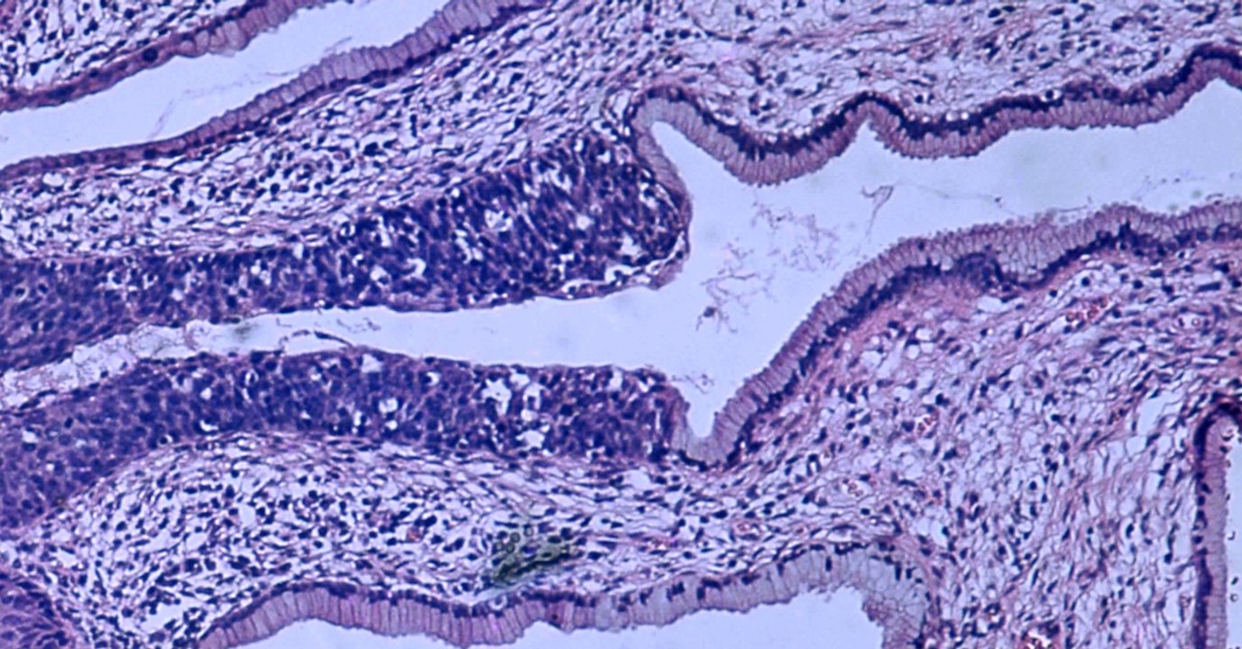 Cancer du col de l'utérus : l'Australie serait en passe d'éradiquer la maladie