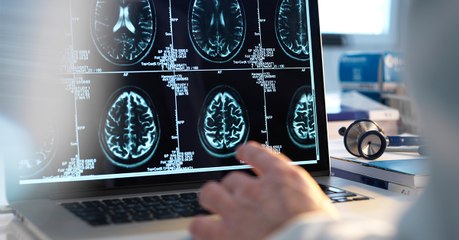La maladie d'Alzheimer pourrait être favorisée par un manque de nettoyage des cellules du cerveau