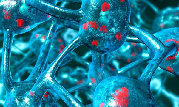 Parkinson : les scientifiques alertent sur une « pandémie »