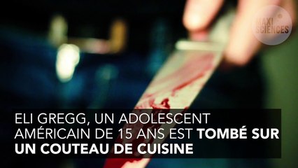 Un chirurgien enlève un couteau de 25 centimètres du visage d'un ado