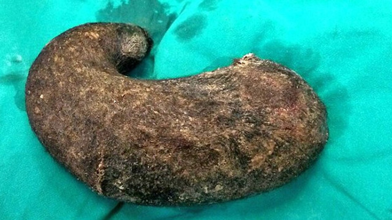 Rapunzel-Syndrom: Wenn Menschen ihre Haare essen...