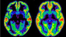 Schizophrénie : définition, symptômes, traitement, causes, qu'est ce que c'est ?