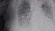 Covid-19 : les conséquences sur les poumons révélées par une nouvelle étude de l'Université d'Oxford