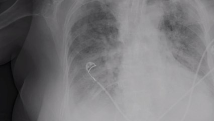 Covid-19 : les conséquences sur les poumons révélées par une nouvelle étude de l'Université d'Oxford